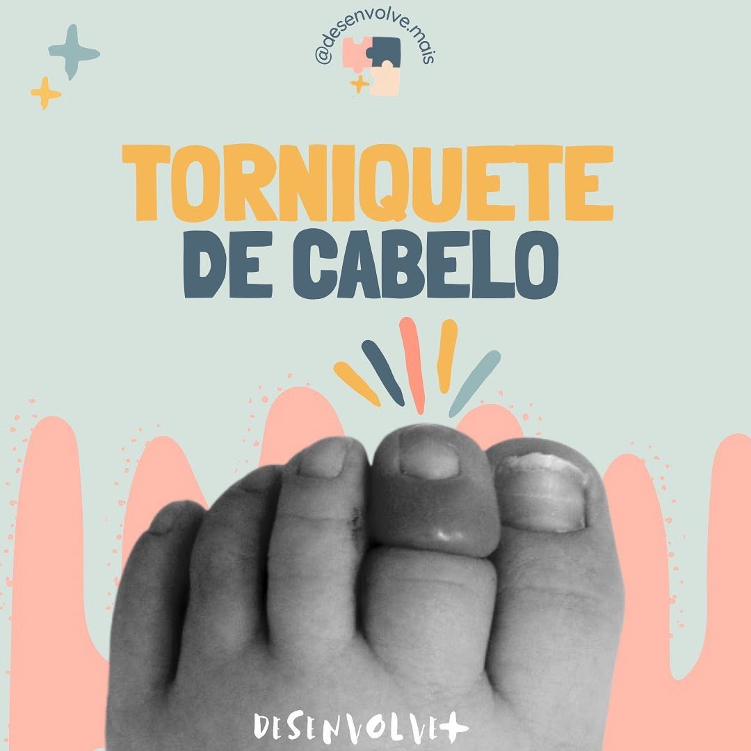 ⭐️ TORNIQUETE DE CABELO ⭐️ 

Ocorre quando um fio de cabelo envolve uma parte do corpo e interrompe a circulação. Os torniquetes de cabelo podem danificar os nervos, o tecido da pele e a função dessa parte do corpo.

Os torniquetes de cabelo podem afetar os dedos das mãos e dos pés, genitais ou qualquer outro membro. Um torniquete de “cabelo” também pode ser causado por um pedaço fino de linha ou barbante.

Geralmente afetam apenas bebês pequenos porque seus membros são tão pequenos que um fio d