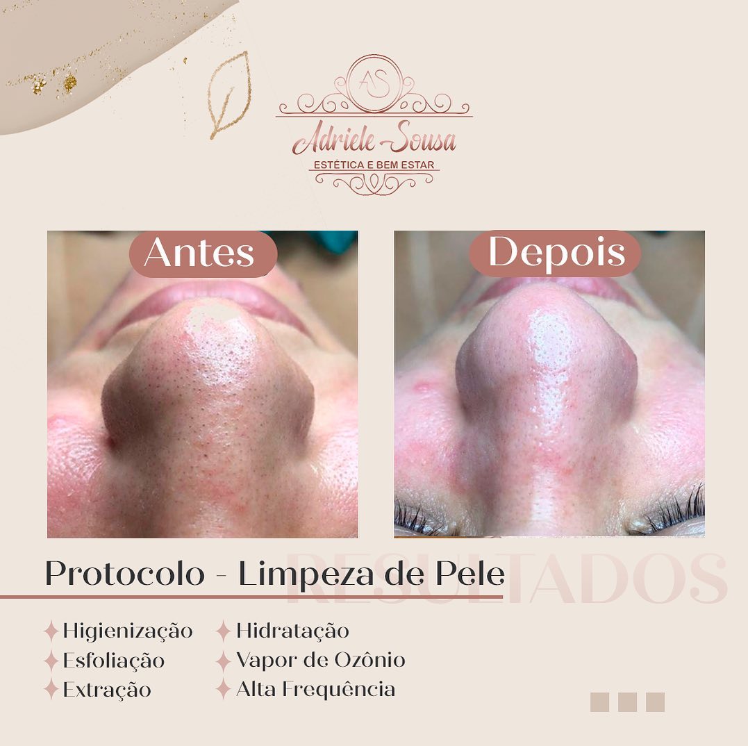 ✨ Meninas vocês estão com a sua limpeza de pele em dia? 

✨ O principal benefício desse procedimento maravilhoso  é que ajuda a remover as células mortas e cravos indesejados que estão presentes na camada superficial da pele. A limpeza de pele também é capaz de equilibrar o PH da epiderme, o que deixa a pele mais firme, hidratada, elástica e resulta em uma aparência mais jovem.

💕 Vamos cuidar das cutis?

Entre em contato comigo!
📲 (85) 98912-9998

#limpezadepele #peleperfeita #pelesaudavel #p