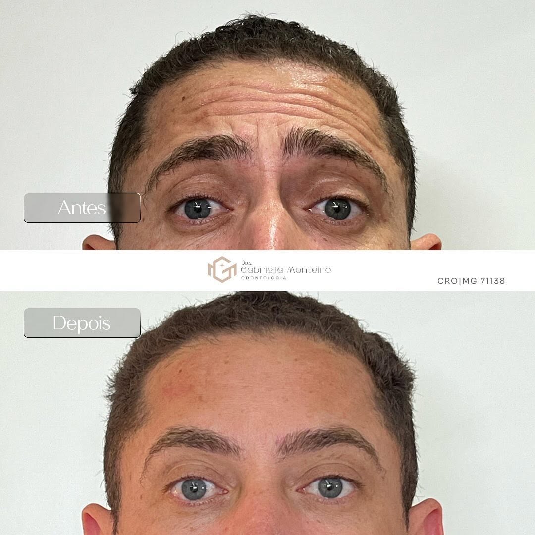 Que o botox é vida nós já sabemos, né ? 🤩 Olhem esse resultado que incrível e natural! Nada melhor que se olhar no espelho, fazer as expressões, e não ter mais as rugas indesejadas.

Você também tem essa vontade ? 
📲 Agende sua avaliação comigo e vamos planejar o seu caso. 

▫️As imagens foram previamente autorizadas pelo paciente. 

Dra. Gabriella Monteiro.
CRO|MG 71138.
