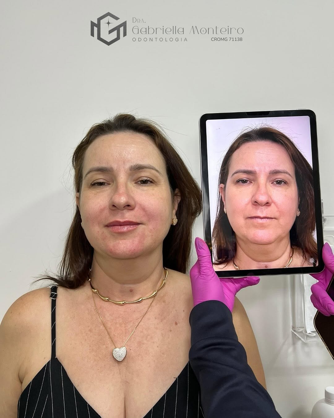 Harmonização Facial ✨🤌🏼🖌️

Um caso super especial, conseguimos um rosto mais harmonioso e descansado, com naturalidade. 

Preenchimento com Ácido hialurônico, nas regiões: 
- labial 
- mento 
- bigode chinês 
- marionete 

Dra. Gabriella Monteiro 
CROMG 71138

#hof #harmonizacaofacial #preenchimento #estetica #naturalidade