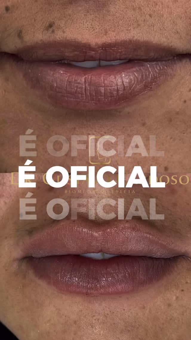 ✨ Esquenta Black Friday Dermalift ✨

O momento de se cuidar chegou! 💆‍♀️
Fim de ano, festas, reencontros… E nada melhor do que estar com a pele e o corpo incríveis pra viver tudo isso com confiança! 💫

As promoções estão imperdíveis e por tempo limitado é o momento de garantir seus procedimentos com condições únicas que só acontecem agora! 🤍

📍Dermalift Estética Avançada
#BlackFridayDermalift #EsquentaBlackFriday #EsteticaAvancada #Autocuidado #BelezaReal #Dermalift