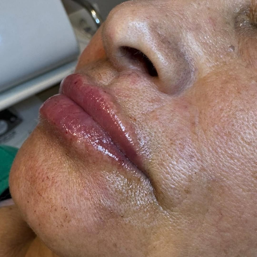 Lábios maduros também merecem cuidado, técnica e respeito à sua anatomia. 
Aqui, o objetivo não é transformar — é restaurar contorno, hidratação e harmonia, valorizando a naturalidade e a individualidade de cada paciente✨
.
.
.
.
.
.
.
.
.
.
.
.
.
.
.
.
.
#estetica #labios #preenchimentolábial #cafelandiapr #maringapr