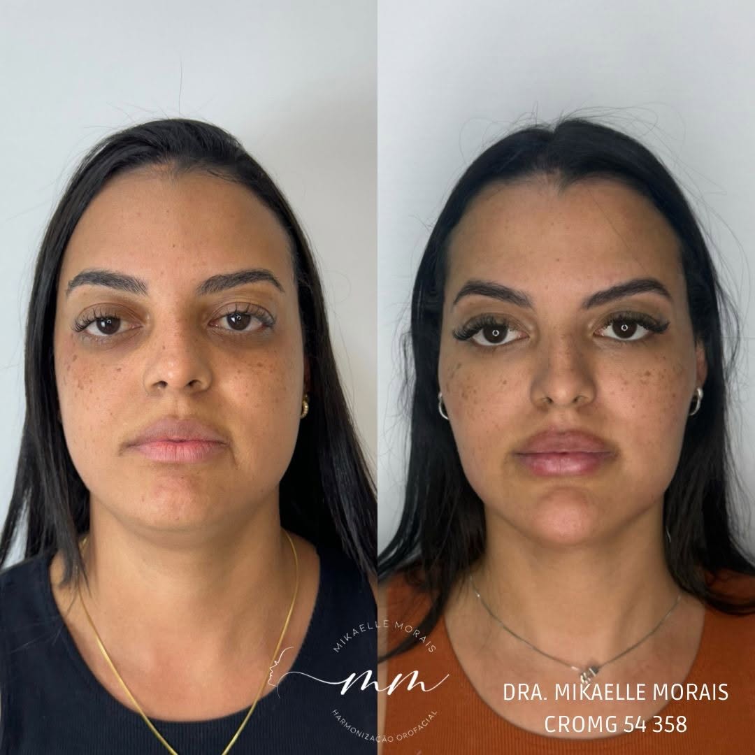 Como um preenchimento no lugar certo pode valorizar o rosto e diminuir a gordura localizada da região da papada sem precisar de uma lipo cervical. 

O antes e depois fala por si: proporção e estrutura fazem TODA a diferença.
O objetivo nunca é mudar o rosto, e sim manter a harmonia, naturalidade e promover a autoestima alta para todo paciente que me procura! 💖

Cada resultado é pensado com cuidado, técnica e muita responsabilidade para realçar o que já é seu. 💛✨

Quer saber mais sobre esse pro