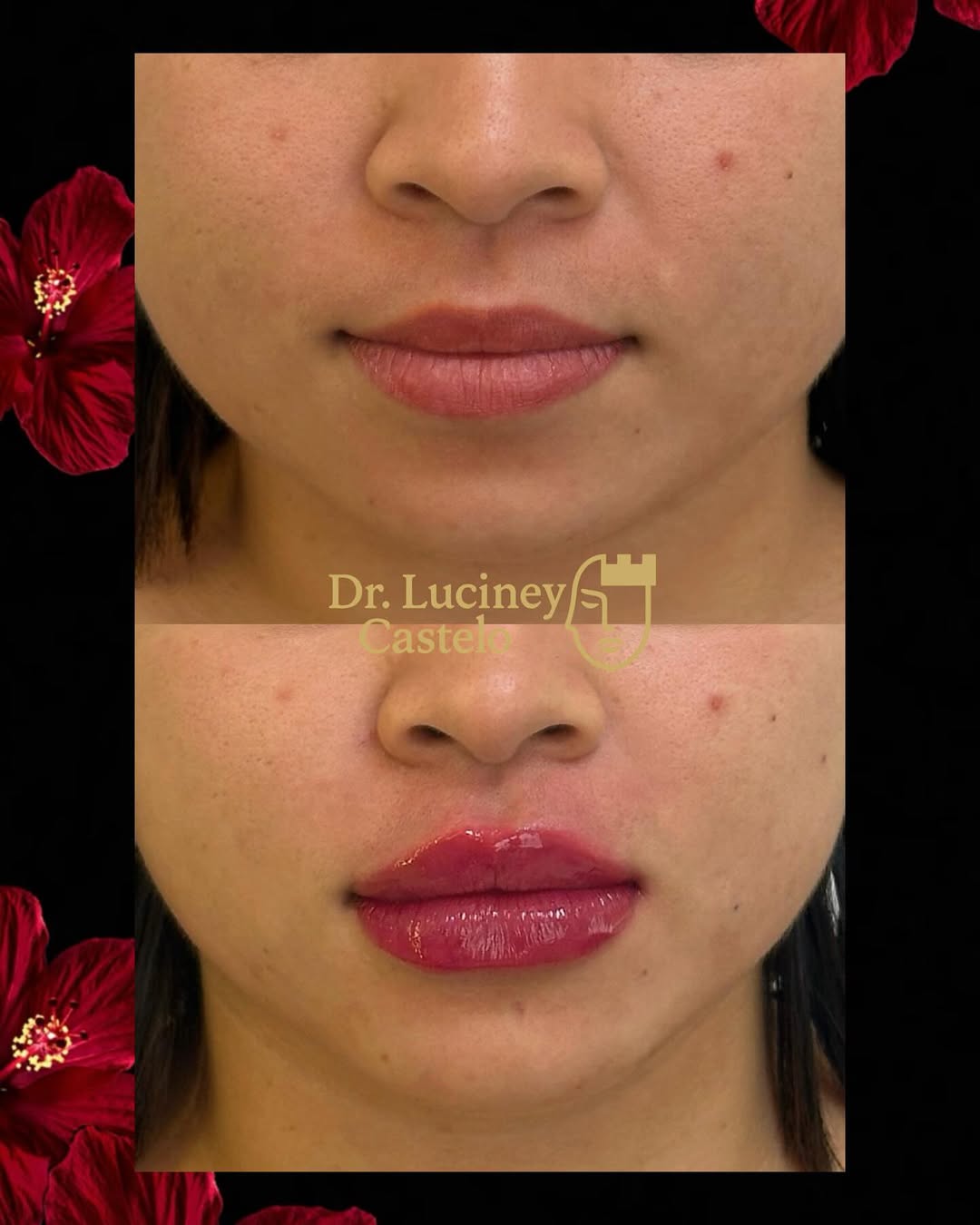 Harmonização labial associada ao preenchimento de sulco nasogeniano (bigode chinês), promovendo mais projeção, contorno e sustentação do terço inferior.

O resultado é um perfil mais estruturado, lábios definidos e um aspecto mais jovem e equilibrado, sem perder a naturalidade.

Se você também deseja melhorar o seu perfil e realçar sua beleza de forma segura e natural, me chama no link da bio para sua avaliação personalizada. 💉✨🔗