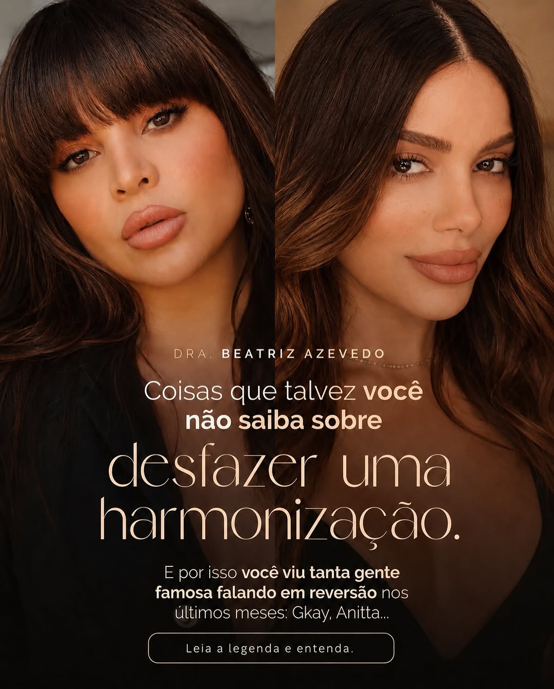 “Dra Bia, se eu não gostar do resultado do preenchimento, tem como remover?”

Essa é uma das perguntas que eu mais escuto no consultório.
E a resposta é: depende.

Quando o preenchimento é feito com ácido hialurônico, existe uma enzima chamada hialuronidase, que consegue dissolver o produto.

Mas eu sempre faço questão de explicar: remover não é tão simples quanto aplicar.

Cada organismo reage de um jeito.
Tem preenchimentos mais antigos, produtos em excesso, migração… e nem sempre conseguimos 