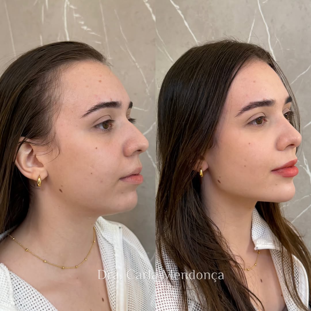 Ela tinha medo de fazer full face.
Medo de exagero e de não se reconhecer.

Mas harmonização bem feita é aquela que chama atenção pela naturalidade, não pelo excesso.

Hoje, depois do resultado, ela me disse:

“Não vivo mais sem, estou me amando como nunca.” ✨