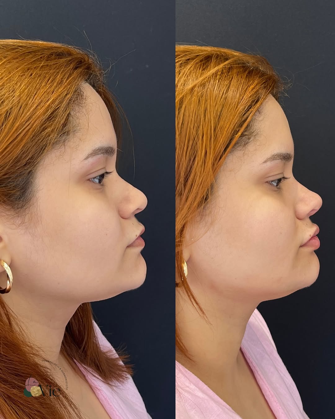 Uma empinadinha que faz toda diferença na harmonia e delicadeza do perfil ✨