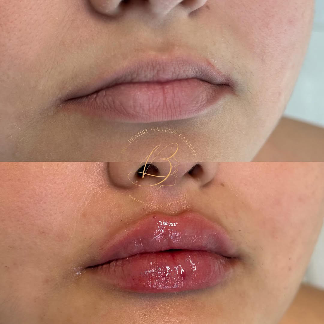 Preenchimento labial com eversão ✨
Essa técnica nos permitiu devolver naturalidade, harmonia e o volume que faltava para valorizar ainda mais seus lábios.

Procedimento realizado pela Dra. Beatriz Gallego Castilho Freire - Cirurgiã Dentista, portadora do CRO/SP 161.656.
* RESOLUÇÃO CFO 196/2019 - autoriza a divulgação autoretratos (selfie) e de imagens relativas ao diagnóstico e ao resultado final de tratamentos odontológicos, e de outras providências.
** Foto autorizada pela paciente.

Dra. Bea