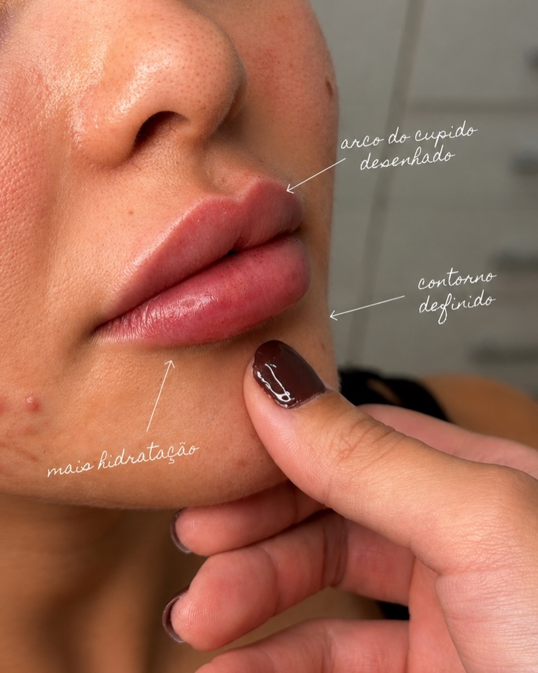 O preenchimento labial vai muito além de volume… ✨
É sobre contorno, hidratação, proporção e naturalidade.
Cada boca é única e o objetivo aqui sempre será realçar sua beleza sem exageros 💉🤍

Resultado leve, elegante e pensado exclusivamente para o seu rosto.

Agendamentos e dúvidas no link da bio 📲