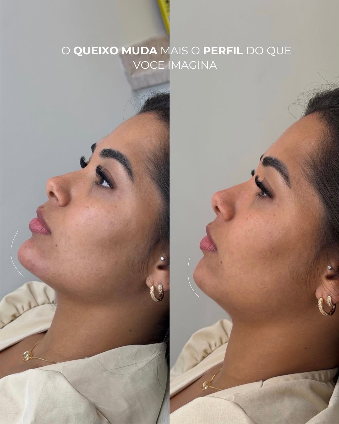 O queixo muda mais o perfil do que você imagina.

Na análise de perfil, avaliamos a Linha E de Ricketts ,uma linha estética que analisa o equilíbrio entre nariz, lábios e mento (queixo).

Quando esses pontos estão desproporcionais, o perfil pode perder harmonia visualmente.

Pequenos ajustes estratégicos são capazes de transformar completamente a leitura do perfil.

Muitas vezes, o que falta para harmonizar o perfil é apenas o ajuste estratégico do mento.

Clique no link da bio e agende sua cons
