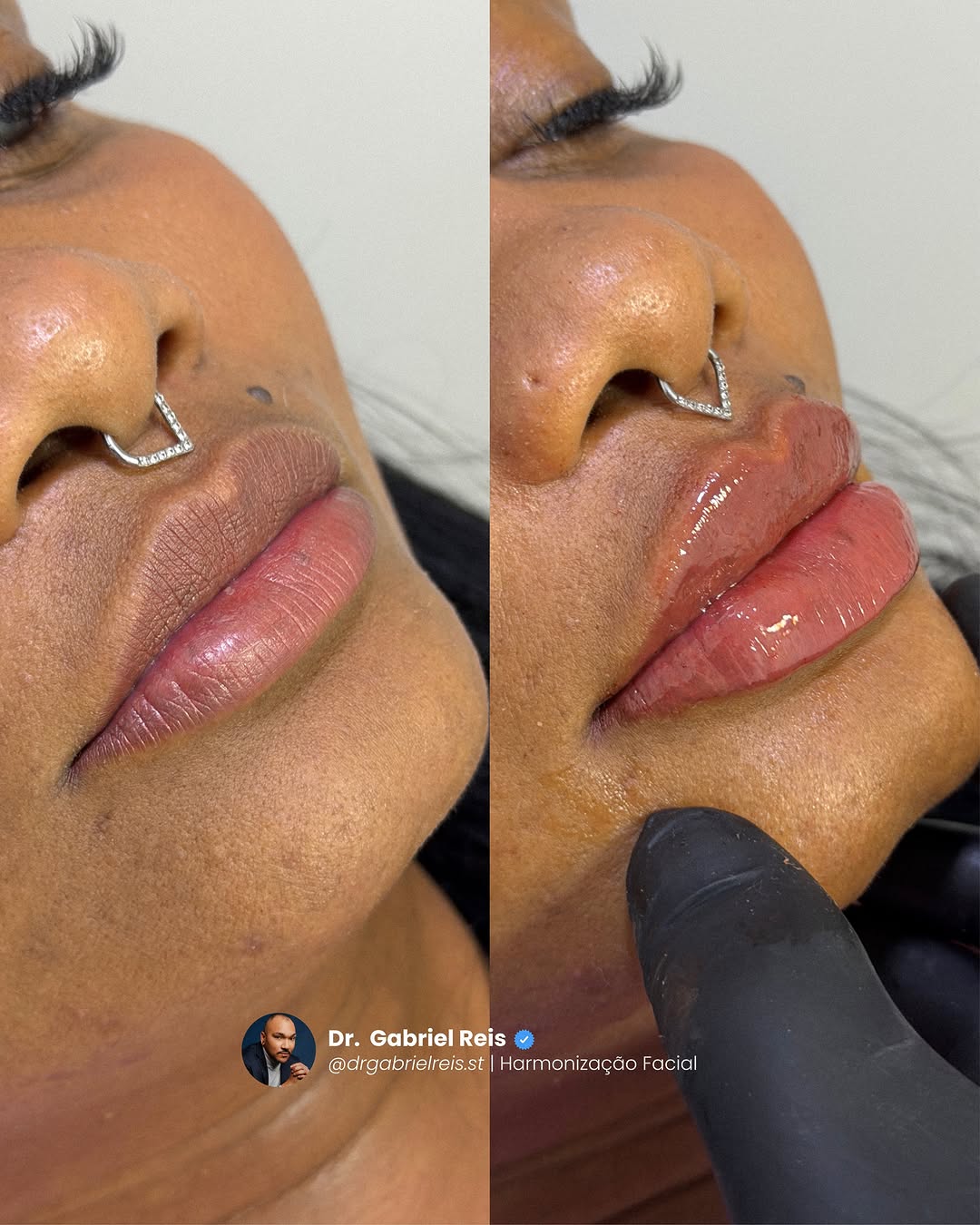 Beleza que não se impõe. Se revela.

Antes: lábios com pouca definição, sem harmonia com o sorriso. Depois: volume na medida exata, contorno preciso e naturalidade absoluta.

O preenchimento labial, quando bem indicado e cuidadosamente executado, não transforma — refina. Valoriza traços, respeita proporções e entrega elegância em cada detalhe.

Resultado pensado, planejado e personalizado. Porque sofisticação está no equilíbrio. E luxo é parecer naturalmente impecável.