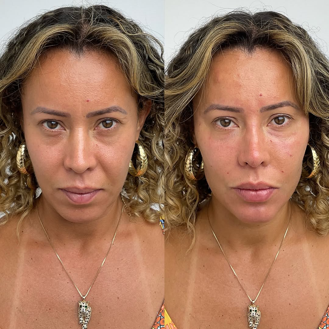 Detalhes que fazem a diferença. Naturalidade é harmonia.  Agende sua avaliação pelo link da bio! #harmonizacaofacial  #embelezamento