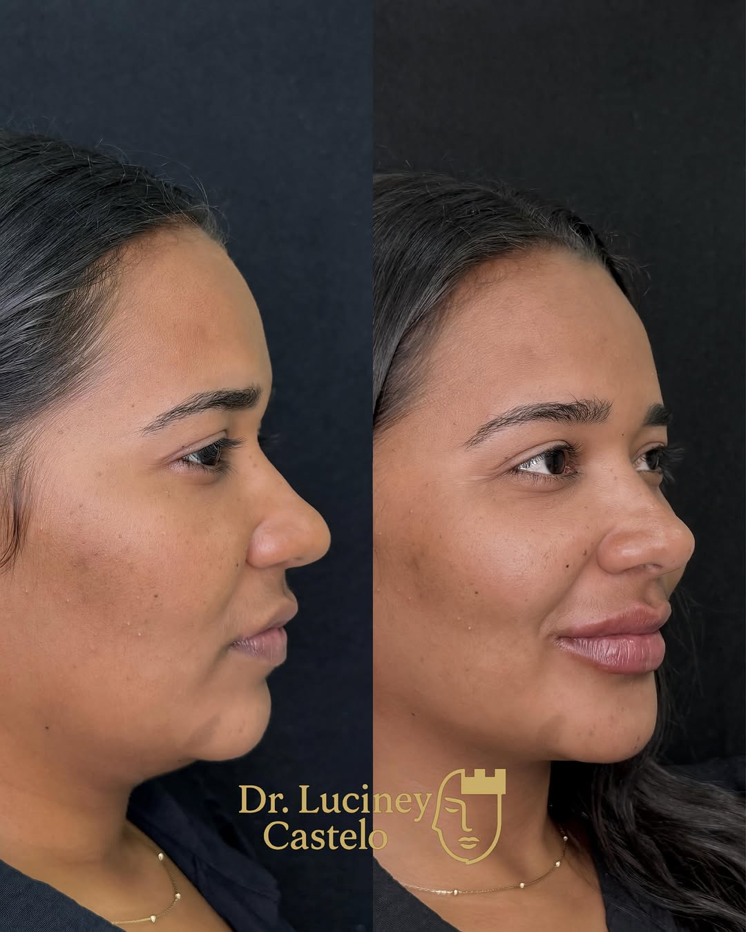 Através da harmonização facial conseguimos valorizar seu perfil, melhorar a projeção do rosto e trazer mais equilíbrio facial de forma minimamente invasiva e com naturalidade ✨

O objetivo da perfiloplastia não é transformar o rosto, mas harmonizar estruturas que impactam diretamente a estética do perfil, respeitando os traços e a identidade de cada paciente.

Um planejamento facial bem executado faz toda diferença no resultado.

Agende sua avaliação.