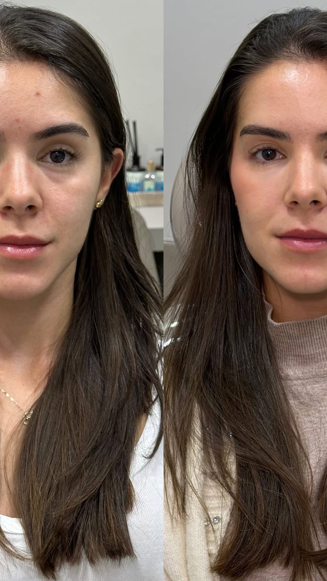 “Você está mais bonita, fez alguma coisa?” Foi o que a Nath mais ouviu depois da harmonização. O tratamento dela foi pensado e perdonalizado PARA ELA, e não como uma “receita de bolo” genérica que deixa todos iguais como vemos por aí. A harmonização facial feita com equilíbrio e sutileza, realçando detalhes estratégicos, faz toda a diferença. É sobre descobrir a sua versão mais linda, sem ficar aparente que você fez procedimentos! E é por isso que eu amo tanto fazer o que eu faço: a transformaçã