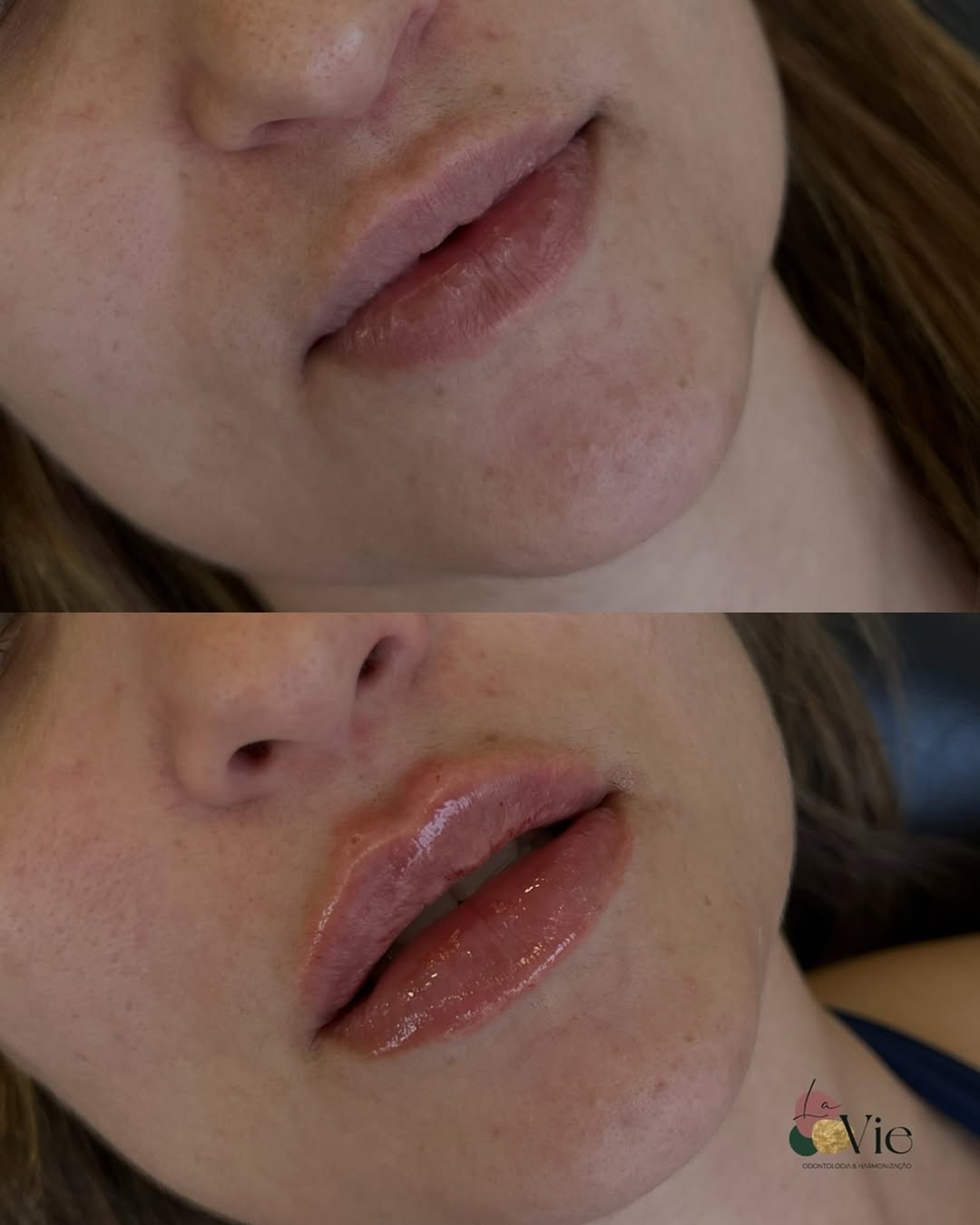 Lábios não precisam perder naturalidade para ganhar força. Contorno definido e hidratação fazem muito mais sentido do que volume exagerado!