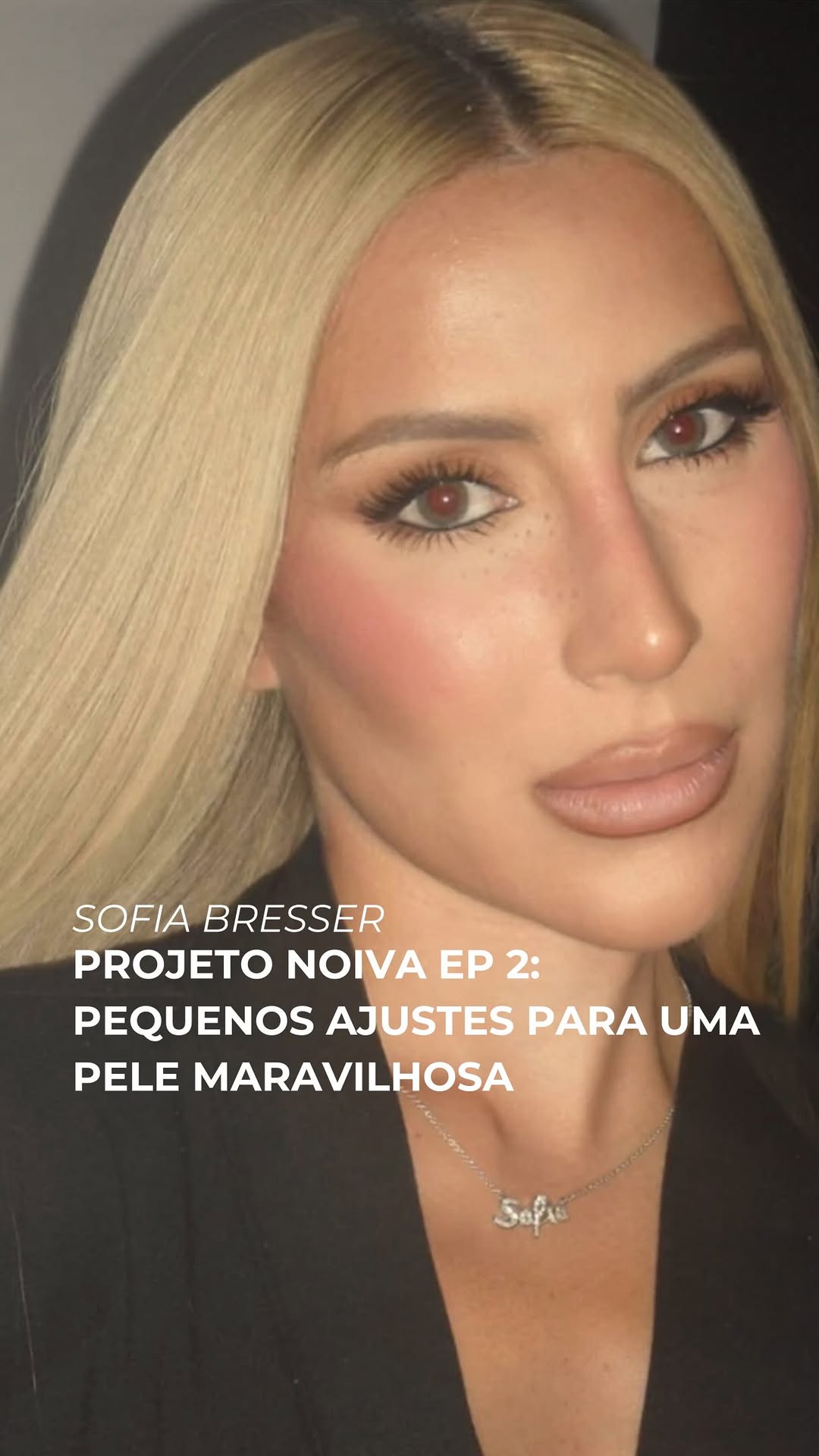 Projeto noiva da Sofia Bresser: é sobre isso, ajustes sutis, estratégicos e personalizados para deixar a pele radiante, viçosa e abrir o olhar para ficar impecável no grande dia. 

Nesse episódio, focamos nos procedimentos que fazem toda a diferença mantendo a naturalidade e valorizando ainda mais a beleza da Sofia 💍🤍

#drwolfvieira #dermatologia