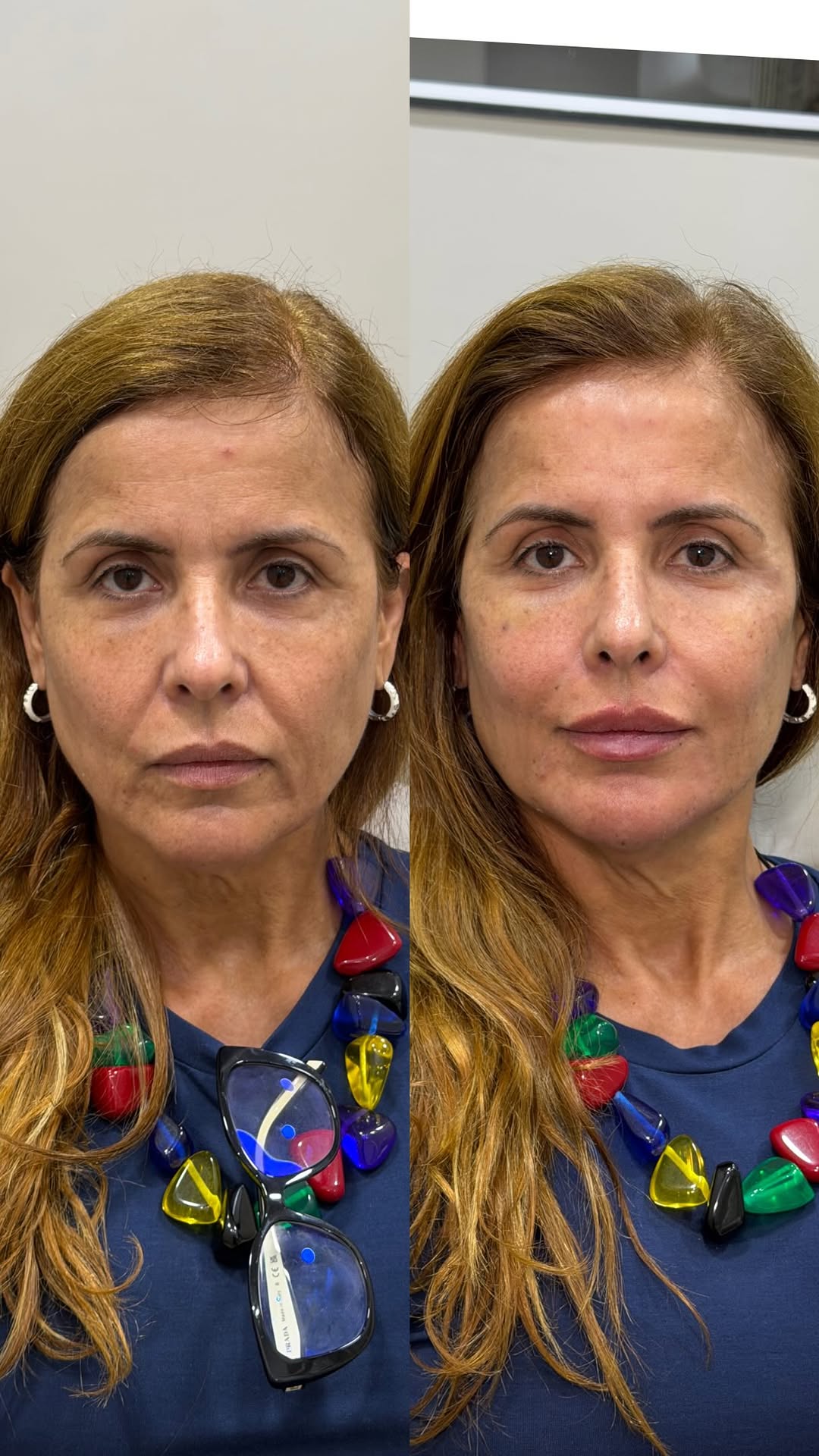 “Quero ficar mais bonita e descansada, mas sem ficar com o rosto diferente.”
Essa frase resume o que escuto todos os dias no consultório.

Muitas mulheres não querem mudar quem são. Não querem que as pessoas percebam um procedimento.
Elas querem se olhar no espelho e enxergar uma versão mais bonita e descansada de si mesmas.
Quando a harmonização facial é bem planejada, o resultado é esse:
VOCÊ.
Só que com menos sinais de cansaço, menos perda de sustentação e mais equilíbrio.
A melhor harmonizaç