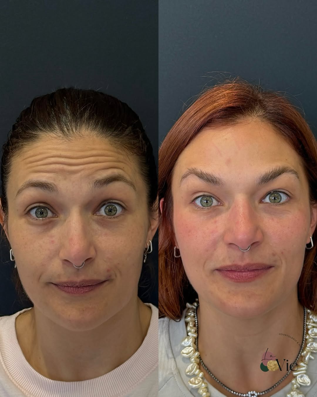 ✨ Um dos primeiros casos de toxina botulínica da Dra. Maethe durante a mentoria

O mais legal da minha mentoria não é apenas aprender a aplicação. É entender o atendimento por completo, desde avaliação até o retorno.

A Dra. Maethe participou da avaliação inicial, do planejamento, da aplicação e também do acompanhamento dessa paciente, observando na prática como cada músculo respondeu, como interpretar o resultado e quando um pequeno ajuste pode deixar tudo ainda melhor.

Porque a toxina não ter