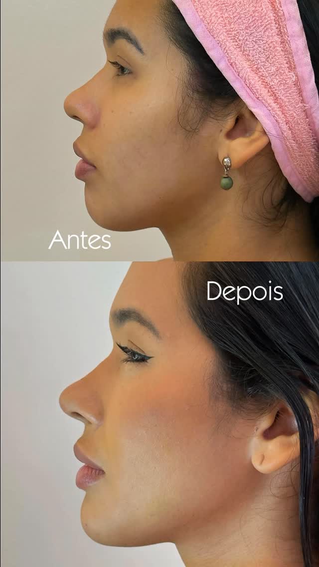 Hoje eu posso dizer que estou extremamente feliz e realizada com o resultado da minha perfiloplastia feito pela Dra. Yasmim 🥹

A perfiloplastia é um conjunto de procedimentos que busca harmonizar o perfil do rosto, criando equilíbrio entre nariz, lábios e mento (queixo). No meu caso, realizamos rinomodelação, preenchimento labial, preenchimento de mento e contorno da mandíbula.

O que mais me encanta é que o resultado respeitou totalmente os meus traços. Eu continuo sendo eu, só que com um rost