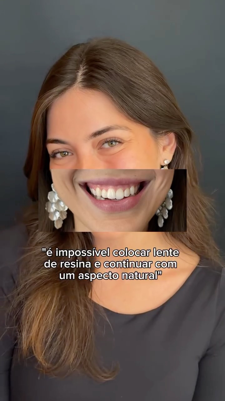 nunca imaginei que conseguiria ter uma transformação tão grande e tão sútil ao mesmo tempo 🤎🥹🌟 feliiiz demais pelo trabalho impecável e a naturalidade do resultado, obrigada @draisabellaronsani 💫 

#antesedepois #resina #dentes #viral #sorriso