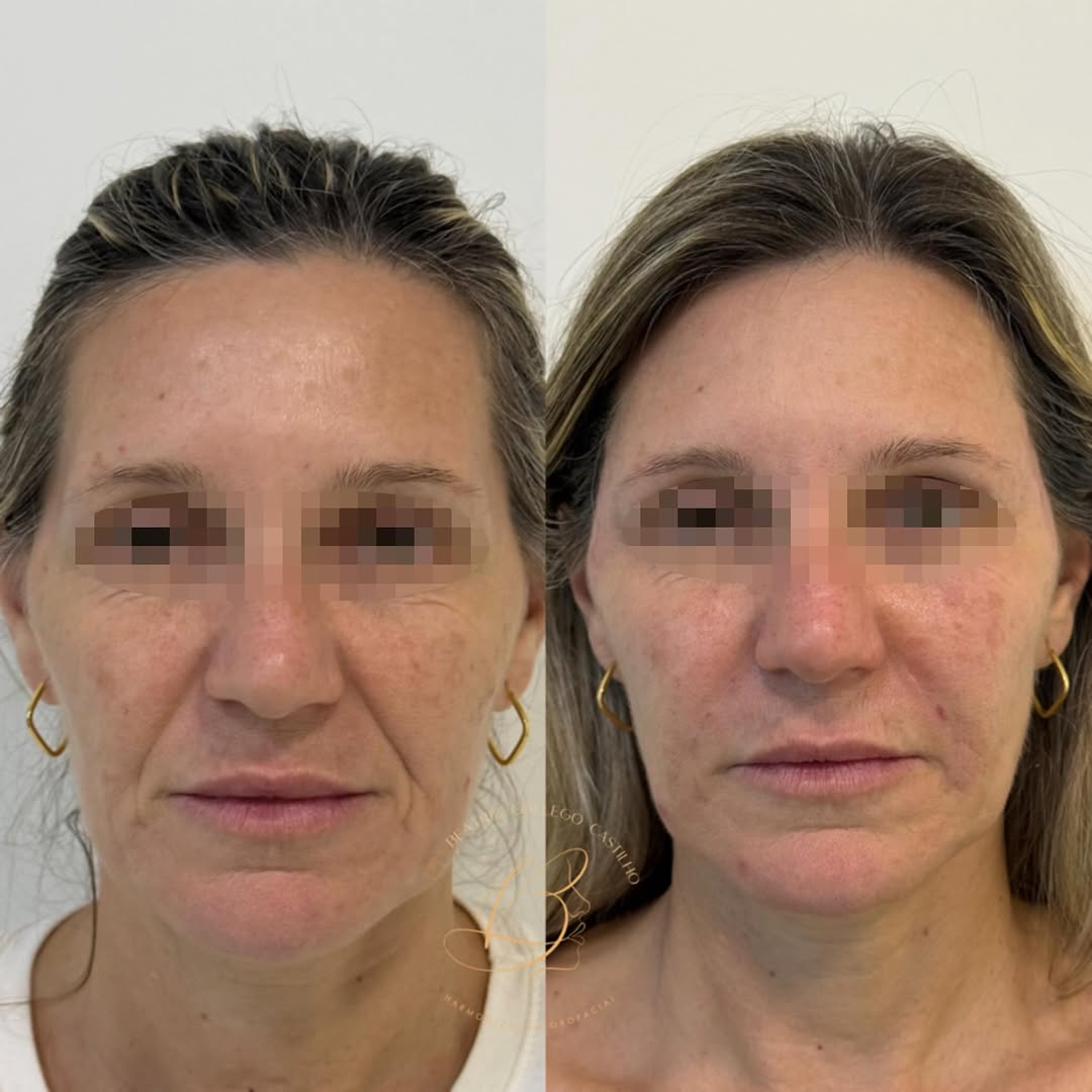 ✨ Reestruturação facial com ácido hialurônico ✨

Recuperando suporte, contorno e harmonia facial através de pontos estratégicos de sustentação, associados ao bioestimulador de colágeno para um resultado natural e duradouro.

Beleza com técnica, equilíbrio e valorização da sua essência. 💫

Procedimento realizado pela Dra. Beatriz Gallego Castilho Freire - Cirurgiã Dentista, portadora do CRO/SP 161.656.
* RESOLUÇÃO CFO 196/2019 - autoriza a divulgação autoretratos (selfie) e de imagens relativas 
