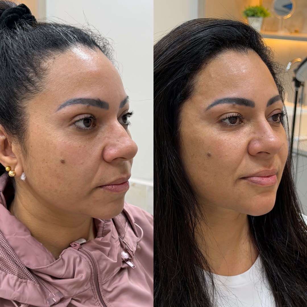 A Ju é aquela mulher que treina, se alimenta bem e valoriza sua saúde.

Fazia o botox regularmente mas, sentia que ainda faltava algo para refletir no rosto toda a sua beleza e vitalidade.

Com muito medo de exageros e de perder sua essência, ela confiou no processo. E o resultado foi exatamente como deveria ser: mais leveza, mais harmonia, mais beleza… sem deixar de ser ela.

Porque os detalhes fazem toda a diferença. 💫

Protocolo CB💫