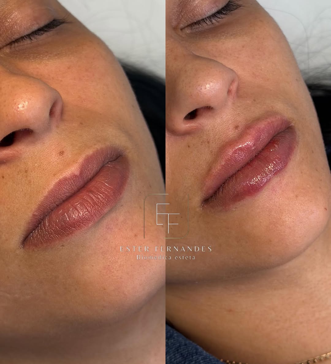 Lábios naturais, contornados e hidratados ✨💋

Essa paciente tinha um desejo muito claro: realçar a beleza dos lábios sem perder a naturalidade. E foi exatamente isso que buscamos entregar: definição do contorno, hidratação e volume na medida certa, respeitando suas características e expectativas.

Por isso, a consulta é uma etapa tão importante. É nela que entendemos suas queixas, objetivos e avaliamos o que realmente faz sentido para alcançar um resultado harmonioso, seguro e satisfatório.

Ca