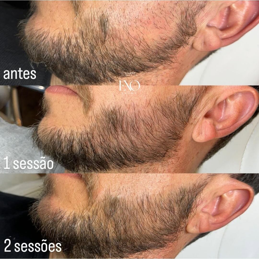 ExoBarba 

Homens também podem fazer o protocolo regenerativo na barba. 
Aquela barba falhada tem solução, barba de verdade crescendo de forma natural. 

Agende já a sua avaliação