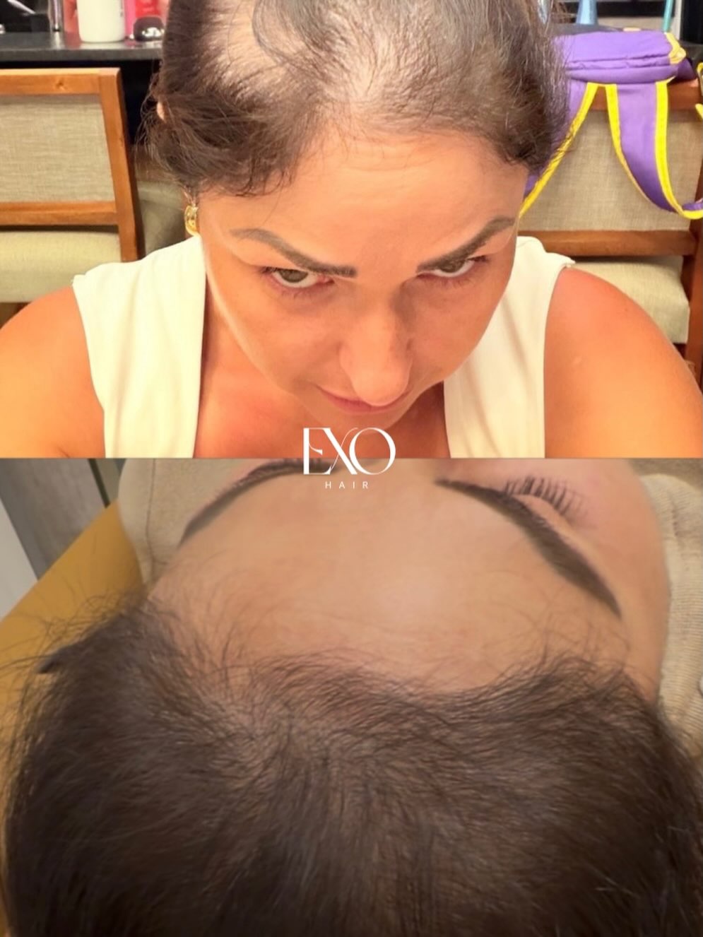 ExoHair 

Com a tecnologia regenerativa do protocolo @exobrows conseguimos estimular e fortalecer os folículos trazendo novamente não só fios novos e fortes, mas também recuperamos a autoestima de cada paciente. 

Quer saber mais e ter esse resultado também comente Eu Quero que te explico como.