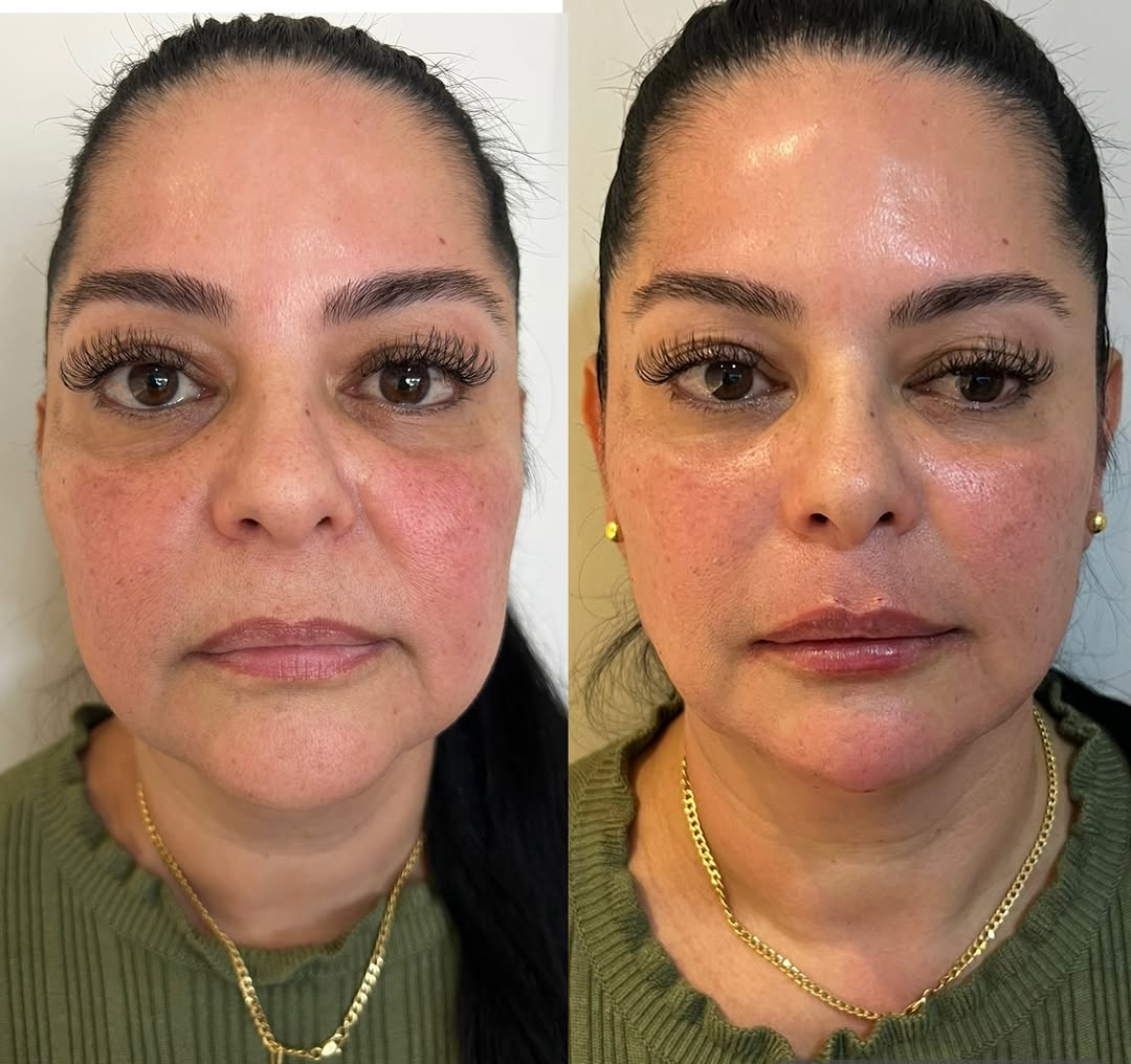 “Eu achava que o problema era a minha papada… até perceber que, muitas vezes, o que falta é estrutura no rosto. “

Nem sempre aquela sombra abaixo do rosto é gordura.
Às vezes, é a ausência de queixo, contorno facial e definição da mandíbula que faz essa região parecer mais pesada.

E isso mexe com a autoestima de um jeito silencioso:
• você evita fotos de perfil
• tenta esconder o rosto em vídeos
• vive procurando o ângulo “certo”
• sente que o rosto nunca fica harmônico

A verdade é que pequen