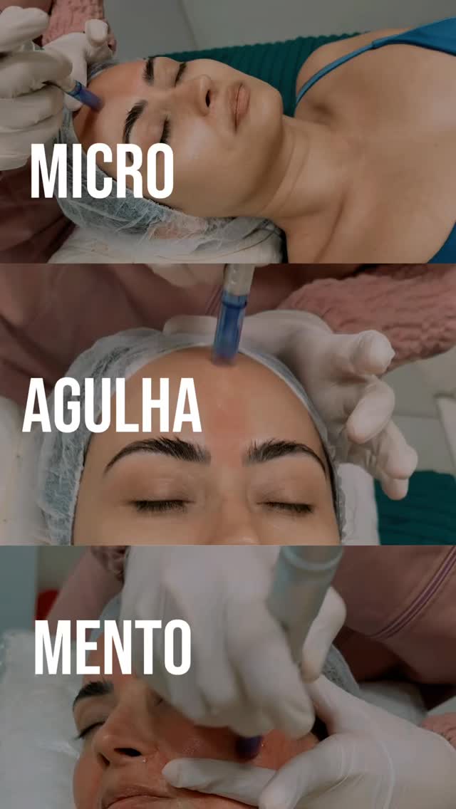 Hoje foi dia de cuidar de mim. ✨

Fiz uma sessão de microagulhamento para estimular o colágeno, renovar a pele e dar aquele glow saudável que a gente ama. 🤍

Confio de olhos fechados no trabalho da Dra. Elisângela, da Bella Estetic, porque além do profissionalismo, ela tem um cuidado e um carinho que fazem toda a diferença.

Agora é seguir os cuidados do pós-procedimento e esperar a pele revelar toda a sua melhor versão. ✨