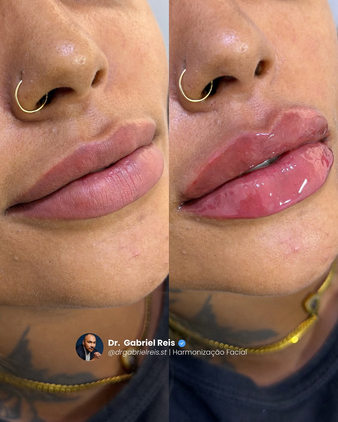 Beleza que não se impõe. Se revela.

Antes: lábios com pouca definição, sem harmonia com o sorriso. Depois: volume na medida exata, contorno preciso e naturalidade absoluta.

O preenchimento labial, quando bem indicado e cuidadosamente executado, não transforma — refina. Valoriza traços, respeita proporções e entrega elegância em cada detalhe.

Resultado pensado, planejado e personalizado. Porque sofisticação está no equilíbrio. E luxo é parecer naturalmente impecável.