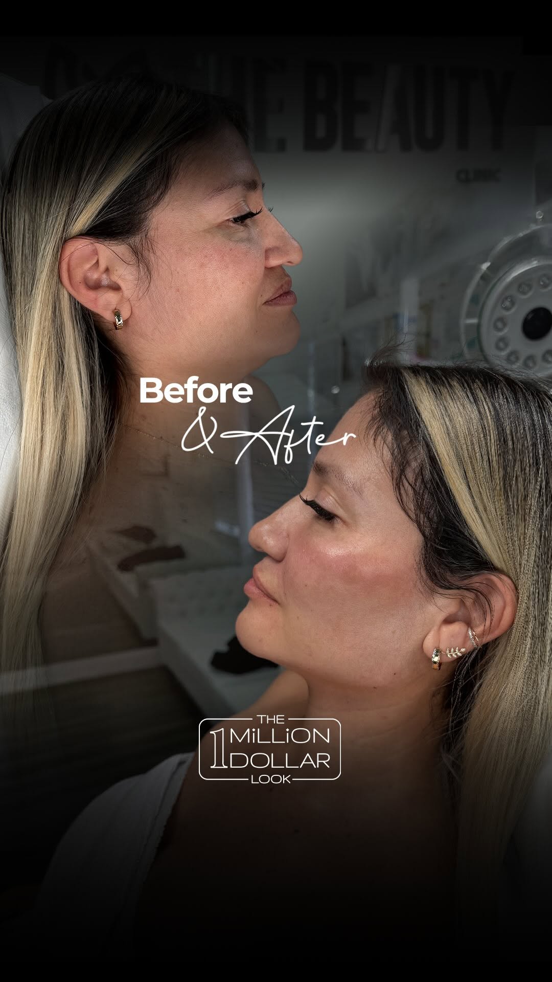 En este caso trabajamos la mandíbula, mentón y cuello para definir el perfil, además de pómulos, triángulo malar y surcos para devolver soporte y frescura al rostro. Finalizamos con un toque sutil en los labios para lograr un resultado armónico, natural y rejuvenecido. 💉✨

¿Te gustaría verte más fresca sin dejar de ser tú? Agenda tu valoración y diseñemos un plan personalizado para ti. 💕

☎️ 813-820-8813📍Miami,Houston
☎️ 813-820-8246📍Tampa

#OneMillionDollarLook #ArmonizacionFacial