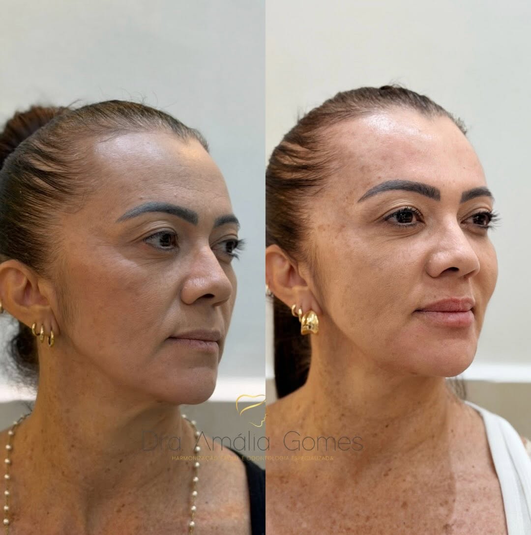 Rejuvenescimento sem excessos.
Mais sustentação, contorno e leveza, mantendo a essência de cada detalhe 🤍
