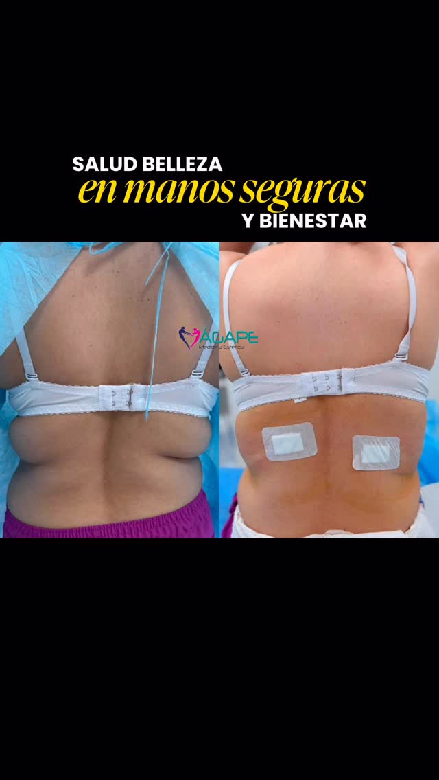 🔥 Descubre QUIMBLÁSER: La revolución en eliminación de grasa localizada y tratamiento de la flacidez 🔥

Foto de antes y después de 4 semanas del tratamiento.

En Centros Médicos Ágape contamos con QUIMBLÁSER, un tratamiento de vanguardia que redefine tu figura de manera segura, efectiva y sin cirugía. Con tecnología avanzada, reduce grasa localizada y mejora la firmeza de la piel, logrando resultados visibles en pocas sesiones.

💎 Resultados notables
⚡ Procedimiento no invasivo
🔬 Última tecn