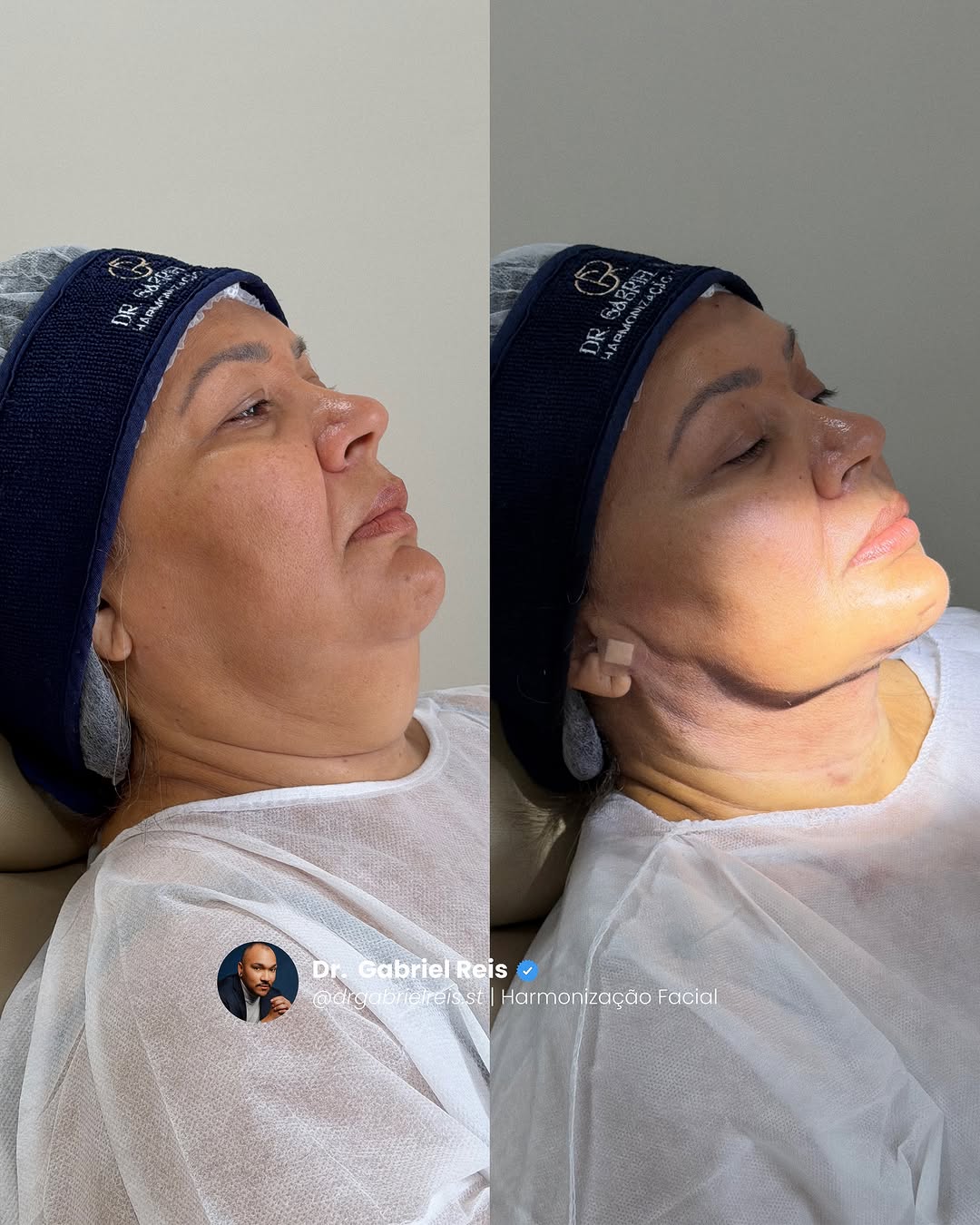 Helena não buscava apenas um procedimento. Ela buscava uma nova versão de si mesma — e teve coragem de dar esse passo. ✨

A lipoaspiração de papada foi um divisor de águas: contorno mais definido, leveza no perfil, harmonia facial e, acima de tudo, confiança renovada. 
Ver o sorriso da Helena após o resultado confirma exatamente o que acredito: quando o tratamento é bem indicado, bem planejado e feito com segurança, o impacto vai muito além do espelho.

Mais do que remover gordura localizada, a 