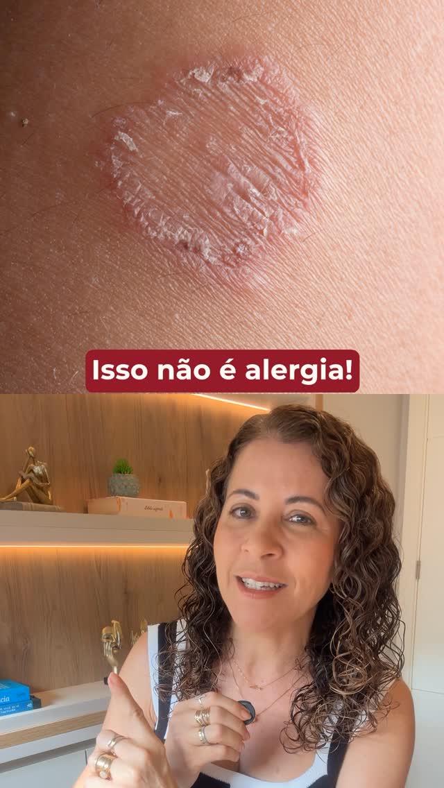 Já apareceu uma mancha vermelha que começou pequena, coçando, e aos poucos foi aumentando e descamando? 👀

⚠️ Nem sempre isso é alergia. 

Em muitos casos, pode ser Tinea Corporis, conhecida popularmente como impinge: uma micose causada por fungos que se proliferam principalmente em ambientes quentes, úmidos e com muito suor. Ela pode surgir após contato com animais, outras pessoas ou até a partir de uma micose que já existe no próprio corpo, como fungos nas unhas, por exemplo.

E existe um det