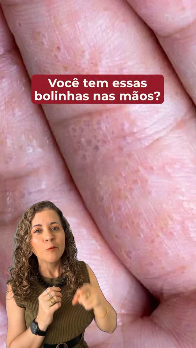 Quando a pele parece que está “gritando” por socorro…

Quem convive com eczema disidrótico sabe que não é apenas uma questão de ressecamento. A coceira intensa, a ardência, as pequenas bolhas e a irritação constante podem impactar diretamente a qualidade de vida.

Foi pensando nisso que desenvolvi um reparador da barreira cutânea formulado para ajudar a acalmar a pele sensibilizada e proporcionar mais conforto nos momentos em que ela mais precisa.

Sua fórmula combina ativos como Niacinamida, Pa